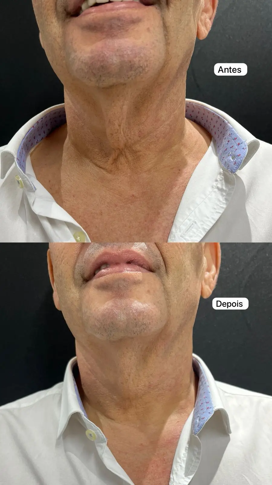 Comparativo antes e depois da pele do rosto e pescoço