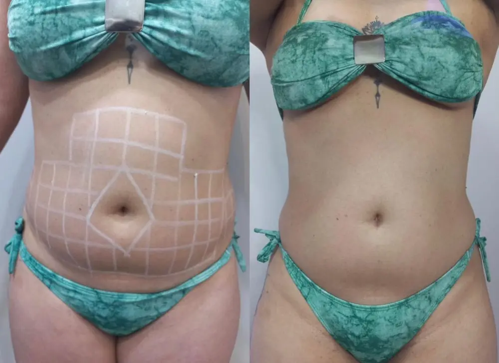 Comparativo de contorno abdominal