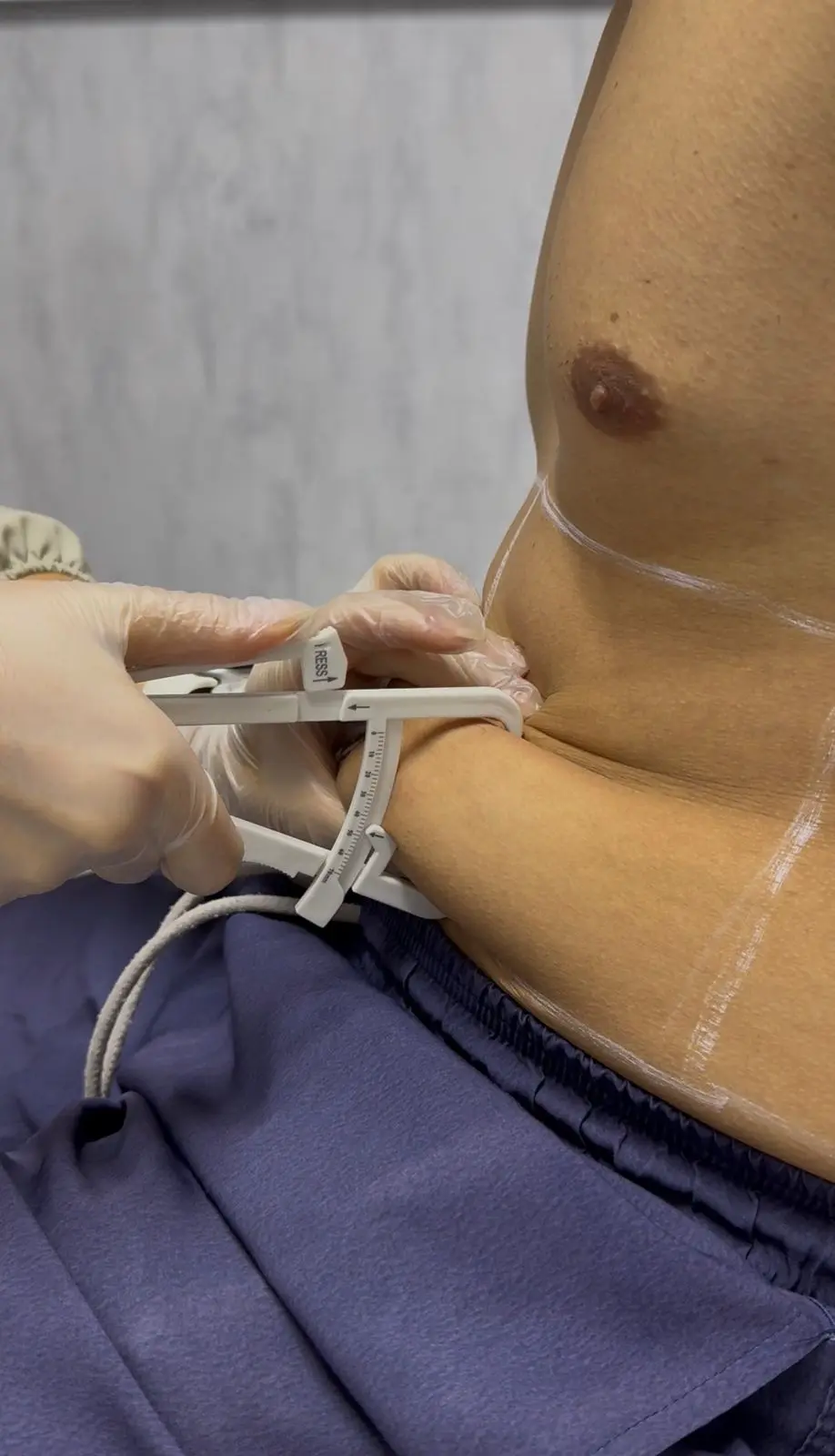 Aplicação do protocolo LipoHD 2.0